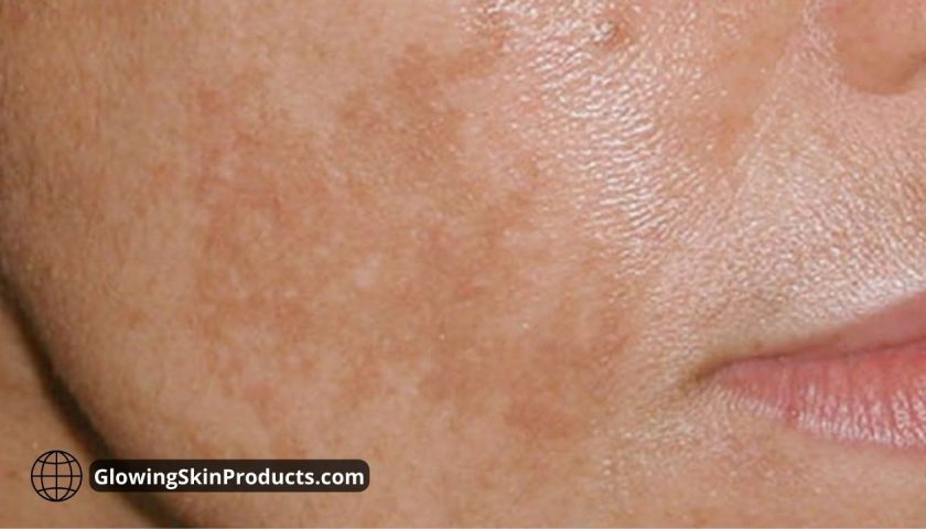 Instant brown spot removal remedy